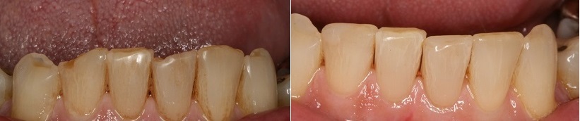 восстановление передних зубов