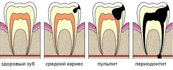 стадии разрушения зуба