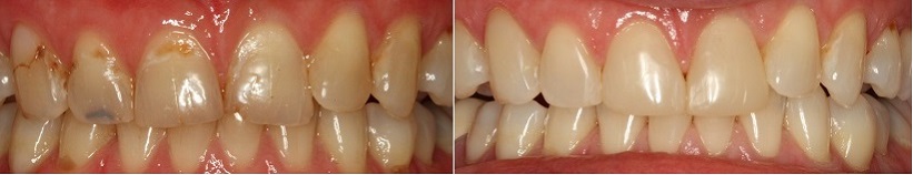 реставрация передних зубов